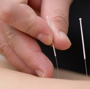 Acupuncture in Lethbridge